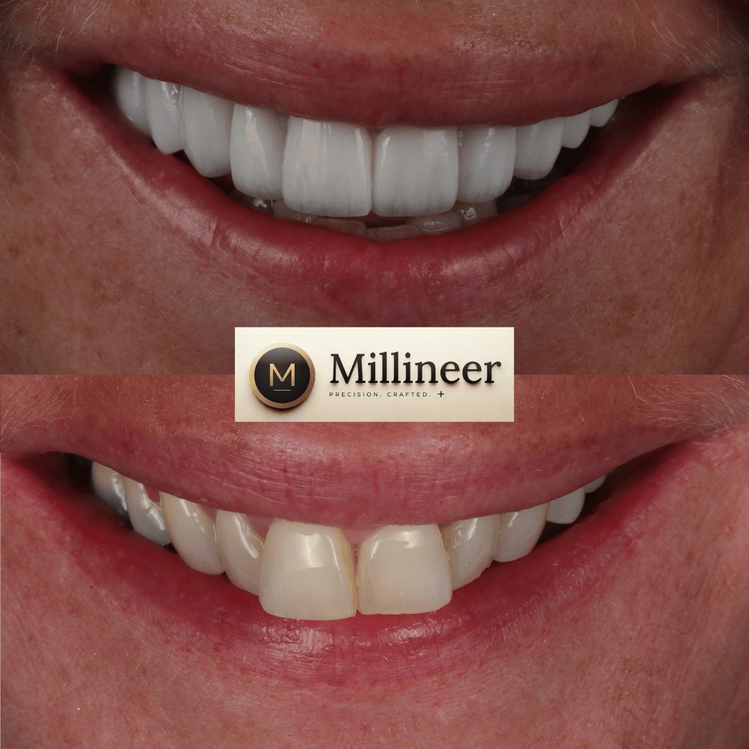 Veneer before and after, Millineer