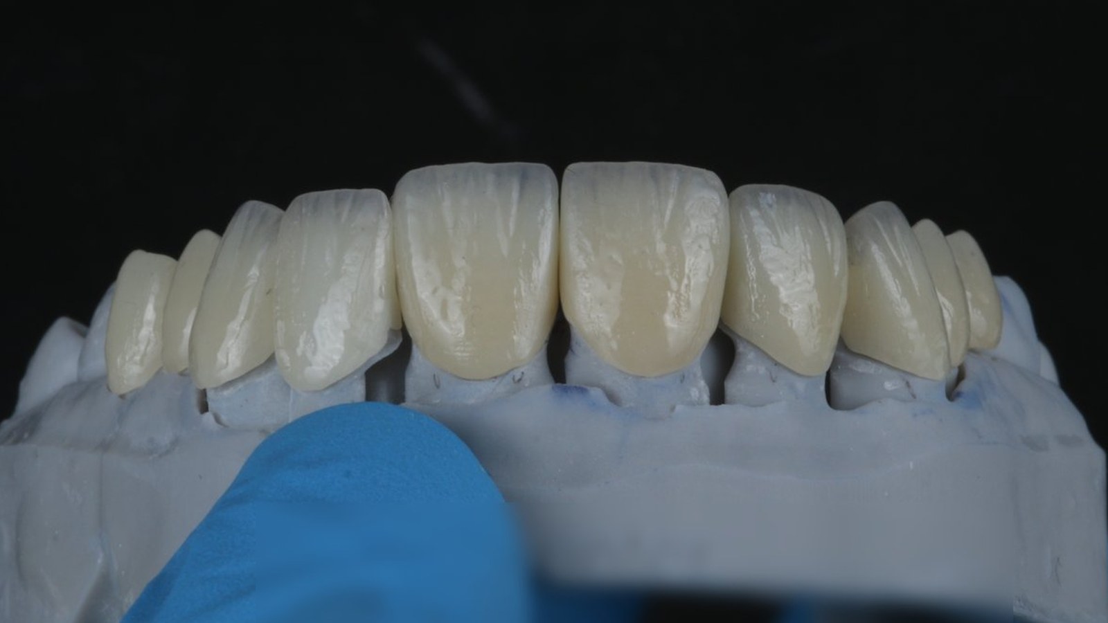 Millineer ceramic veneers in a natural shade, on the lab model