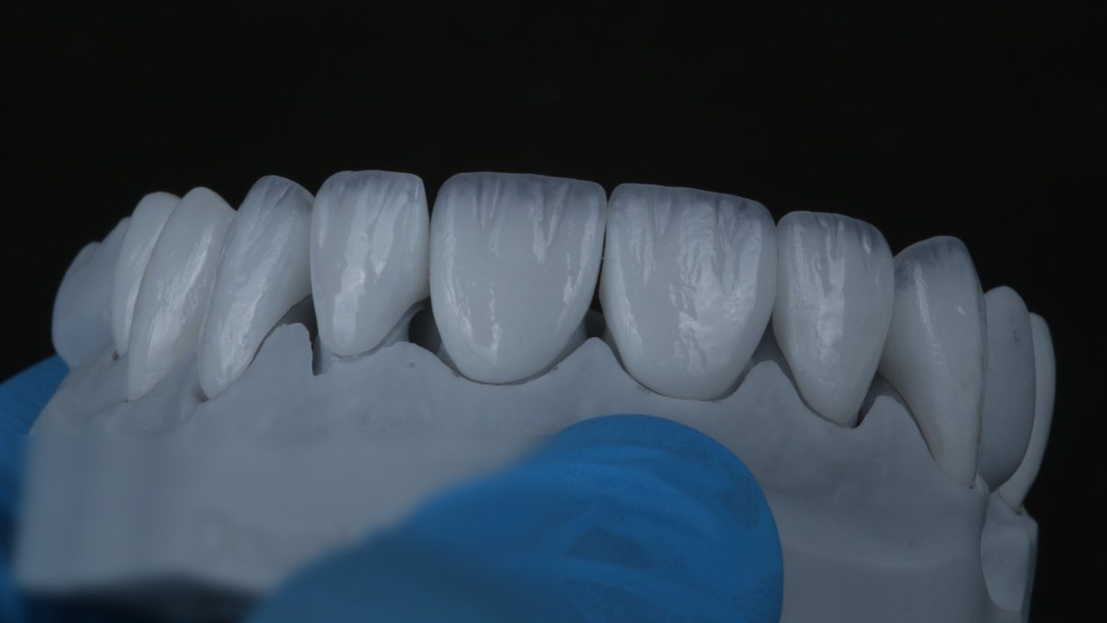 Millineer ceramic veneers in a bright white shade, on the lab model
